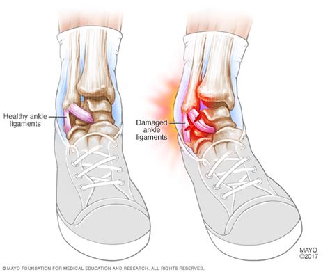 Ankle Sprains | Michigan Sports and Spine Center