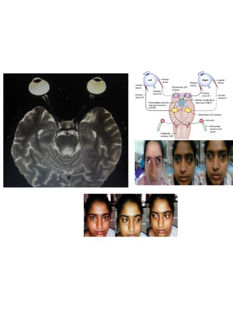 Webino Syndrome (Wall-Eyed Bilateral Internuclear Ophthalmoplegia) | International Journal of ...