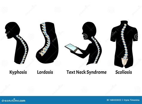 The Position of the Spine with Lordosis, Kyphosis. Text Neck Syndrome ...