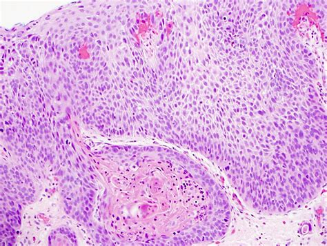 Esophageal Squamous Cell Carcinoma Histology