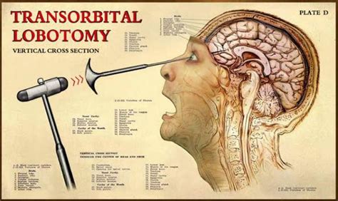 Lobotomy or Prefrontal Leukotomy - MEDizzy