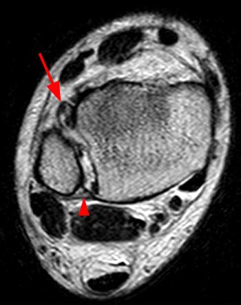 Diagnostic accuracy of clinical tests for diagnosis of ankle ...