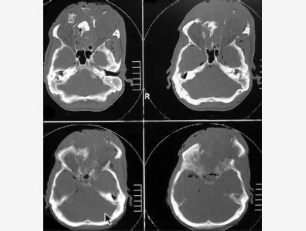 CT showing comminuted fracture of the anterior cranial fossa with loss... | Download Scientific ...