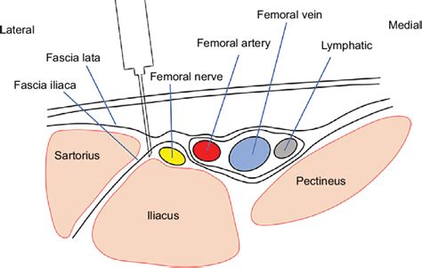 Anatomy-of-the-fascia-iliaca-compartment-block - RCEMLearning