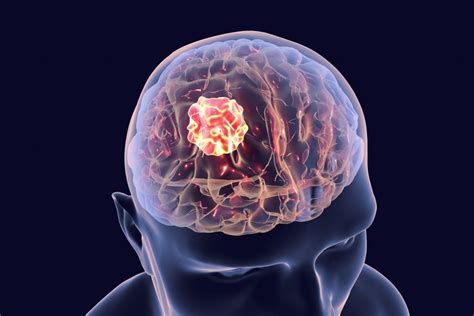 Brain Tumor Stages | TNM Stages and Metastasis | Onco.com