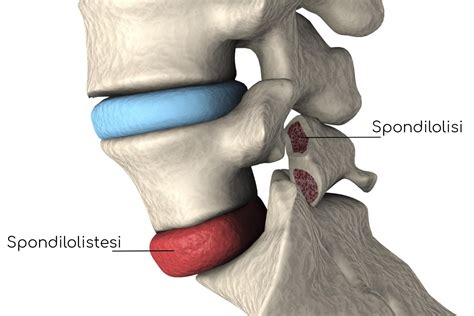 Spondilolistesi: cause, sintomi, pericoli e cura - Valori Normali