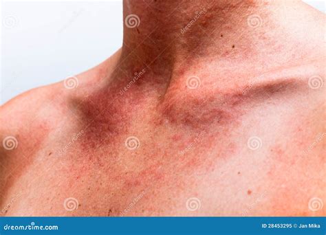 Sun Allergy Royalty Free Stock Photo - Image: 28453295