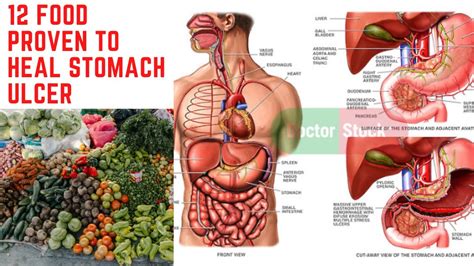 12 Food Proven To Heal Stomach Ulcer - YouTube