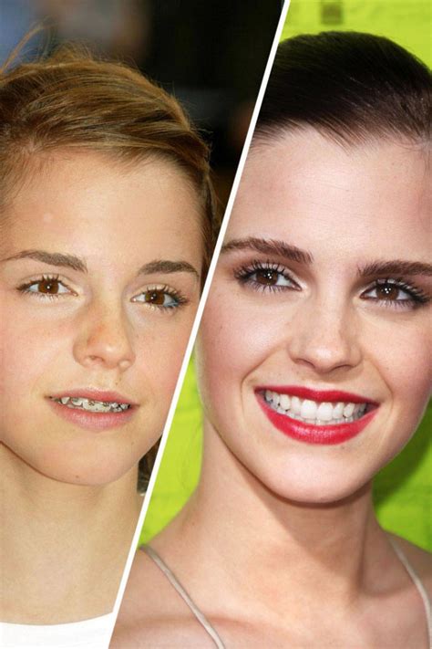 Famous Faces with Braces | Celebrities with braces, Celebrity smiles ...