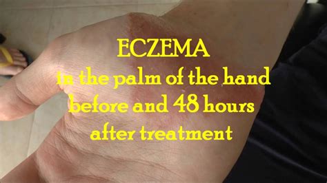 Eczema On Hands Pictures