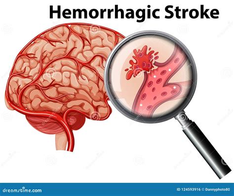 Hemorrhagic Stroke Stock Illustrations – 362 Hemorrhagic Stroke Stock ...