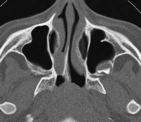 20 Choanal Atresia | Radiology Key