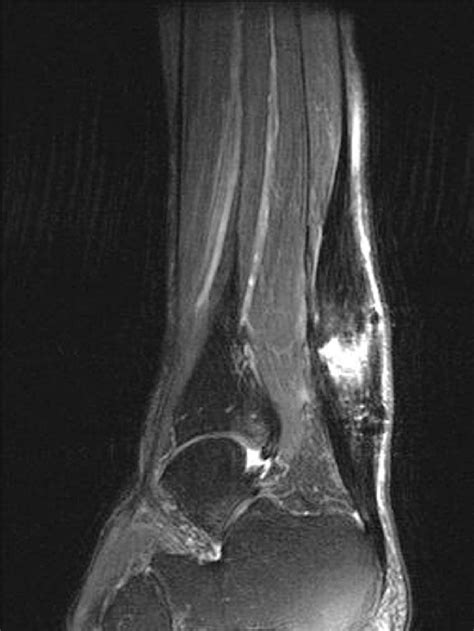 Achilles Tendinosis Mri