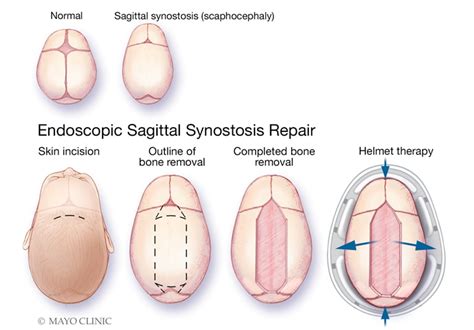 Minimally invasive surgery for craniosynostosis - Mayo Clinic