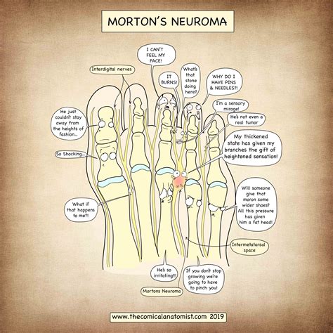 Morton's Neuroma - The Comical Anatomist