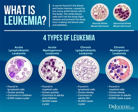 Leukemia: Symptoms, Causes, and Support Strategies - DrJockers.com