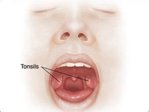 Ayurvedic Treatment of Tonsillitis