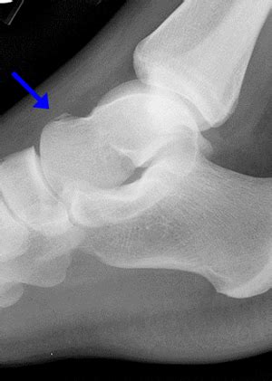 Talus Avulsion Fracture