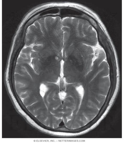 T2 Axial MRI Through the Thalamus and Third Ventricle