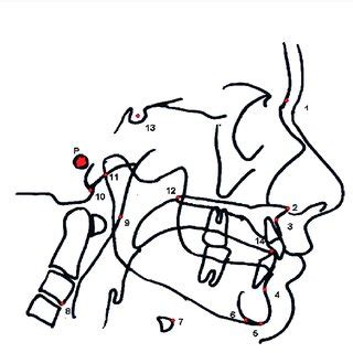 Cephalometric Planes and Angles 1 = gonion-gnathion; 2 = hyoid to... | Download Scientific Diagram