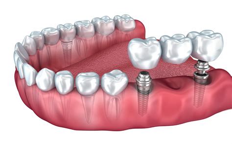 Dental Implants Are a Popular Choice to Replace Missing Teeth - KC Our Health Matters