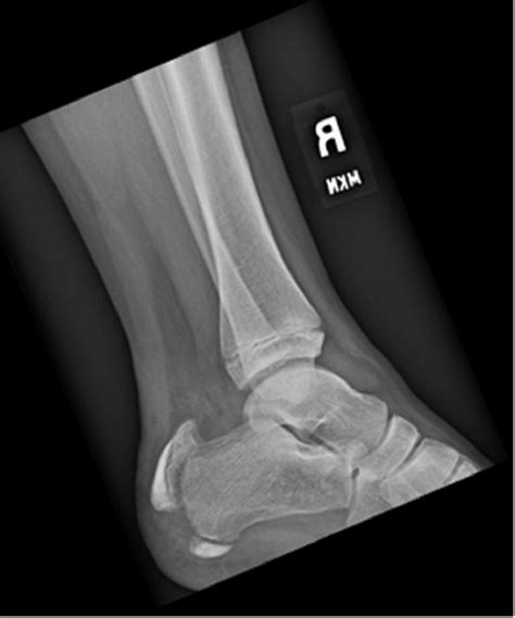 Open Reduction and Internal Fixation of a Pediatric Apophyseal Calcaneus Fracture Using ...