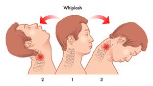 Whiplash Injury Treatment