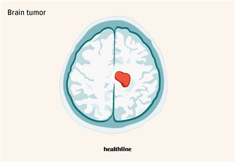 Brain Tumor: Types, Risk Factors, Symptoms, and Treatment