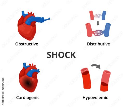 4 types of shock diagram. Medical emergency infographics Stock Vector | Adobe Stock