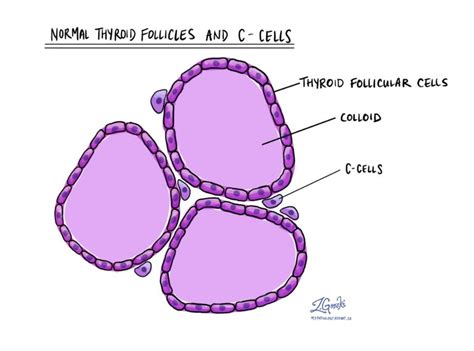 Medullary thyroid carcinoma - Thyroid gland - MyPathologyReport.ca