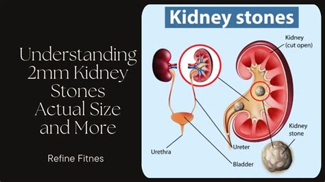 Understanding 2mm Kidney Stones: Actual Size And More