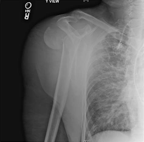 Bilateral Posterior Shoulder Fracture Dislocations after Generalized ...