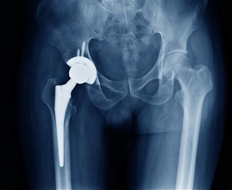 Total Hip Arthroplasty No Better Than Partial Joint Replacement