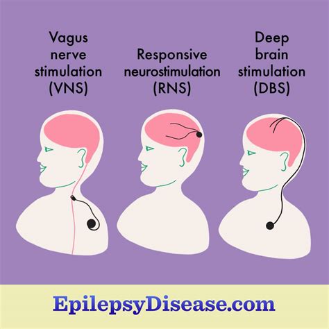 What Are Neuromodulation Devices? | EpilepsyDisease.com