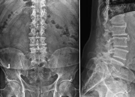 Radiculopathy in the Setting of Multilevel Stenosis and Auto Fused ...