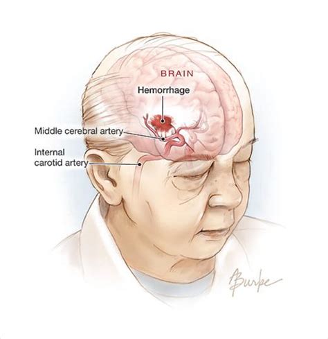 Hemorrhagic Stroke | Cerebrovascular Disease | JAMA | The JAMA Network