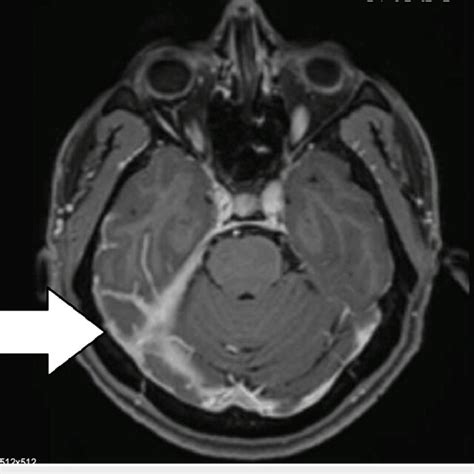 MRI of the brain: T1 axial contrast showing contrast enhancement in the ...