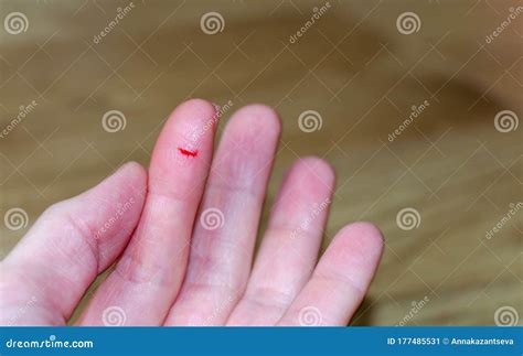 Bleeding from Sharp Cut Wound at Left Index. Finger Cut, Bleeding ...