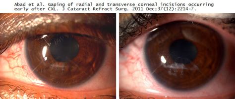 Corneal Collagen Cross-linking, CCL, CXL