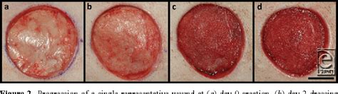 Figure 2 from Comparison of the Effects of Different Negative Pressure Wound Therapy Modes ...