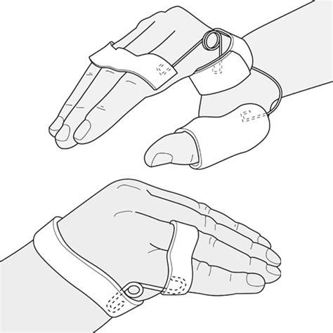 Guide Functional ulnar nerve splint and combined ulnar median nerve splint