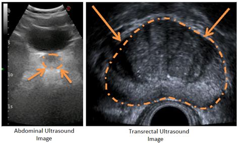 Prostate Anatomy Ultrasound