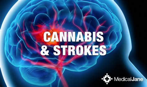 Marijuana May Reduce Brain Damage Caused By Strokes