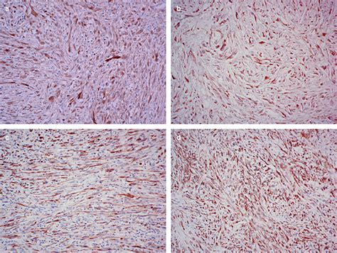 Differential diagnosis of sarcomatoid mesothelioma from true sarcoma ...