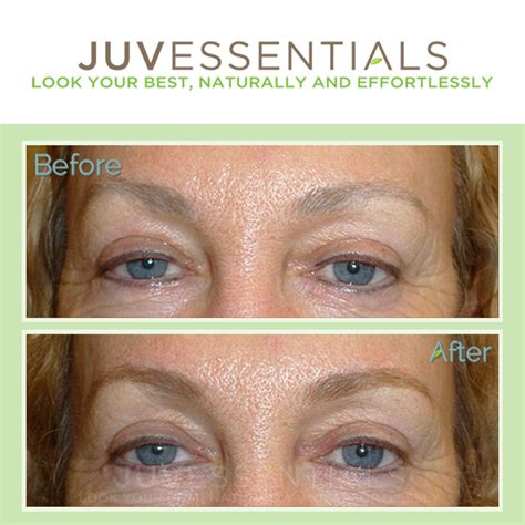 Can eyeliner tattoo be removed or corrected? You bet! Go to http://juvessentials.com to learn ...