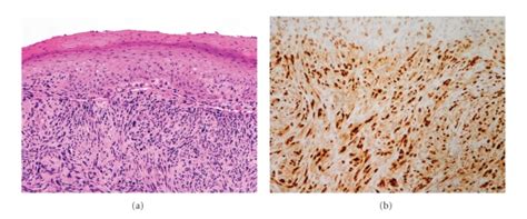 Spindle cell (sarcomatoid) squamous cell carcinoma. (a) The ...