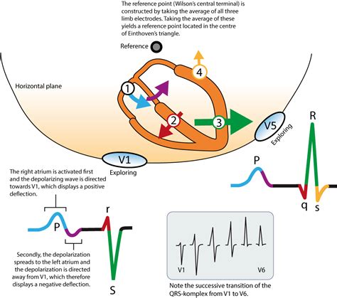 Ecg Positive R Wave In V1 - Article Blog