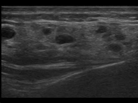 Parotid Gland Parotitis