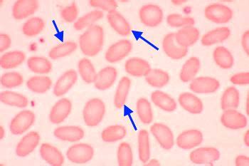 Hello USA: elliptocytes