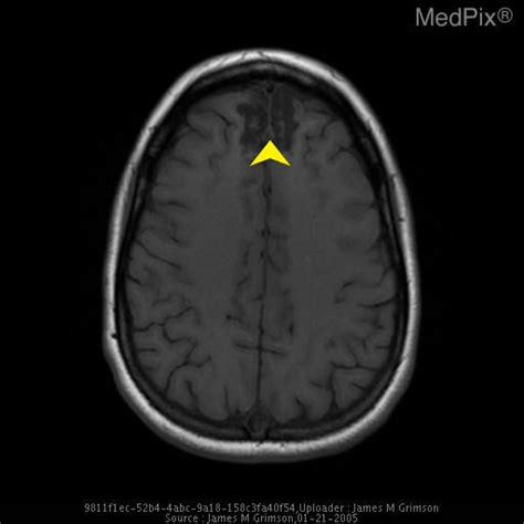 Traumatic Brain Injury Mri